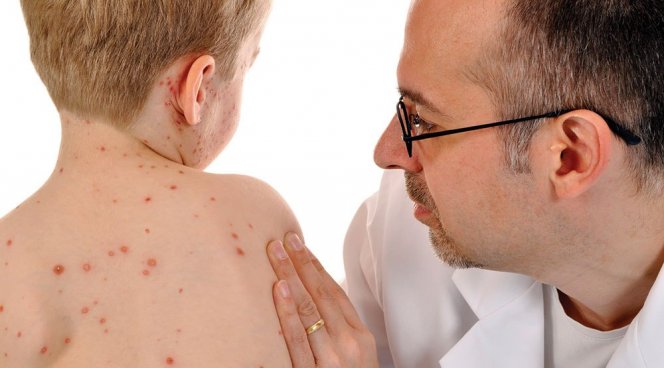 КІР – ХВОРОБА, ЯКУ НЕ МОЖНА ІГНОРУВАТИ!!!