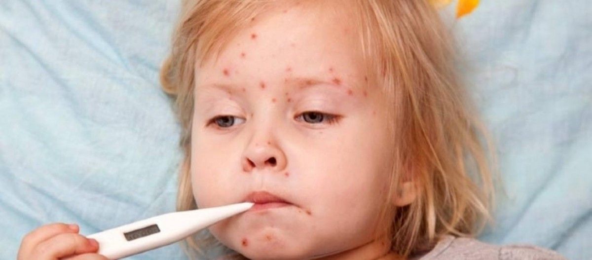 Сумська область повністю забезпечена вакцинами проти кору